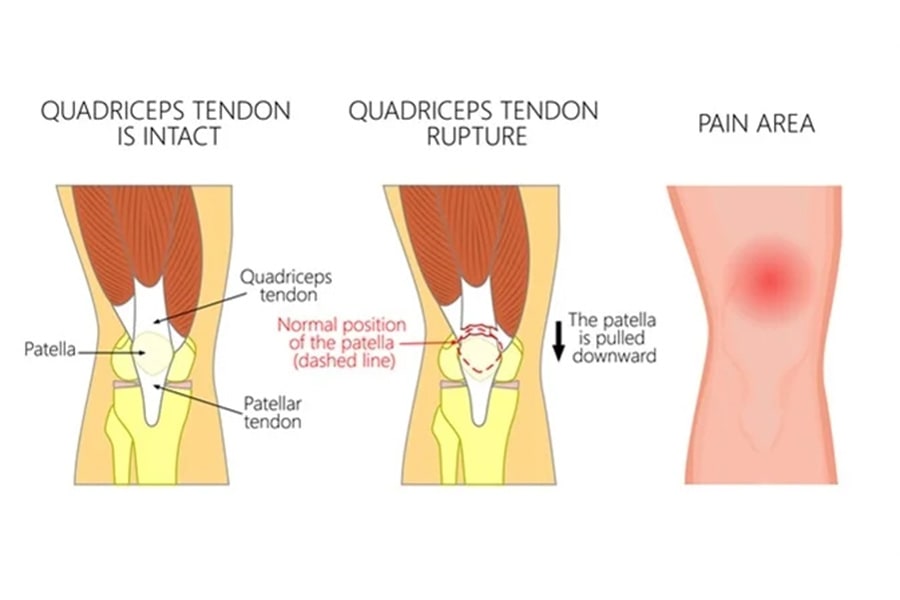 lombalgie tennisman traitement operation chirurgien specialiste sport dos rachis paris docteur patrick houvet philippe paillard